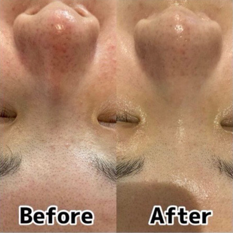 ムートンホイップスパ施術前後の肌の様子