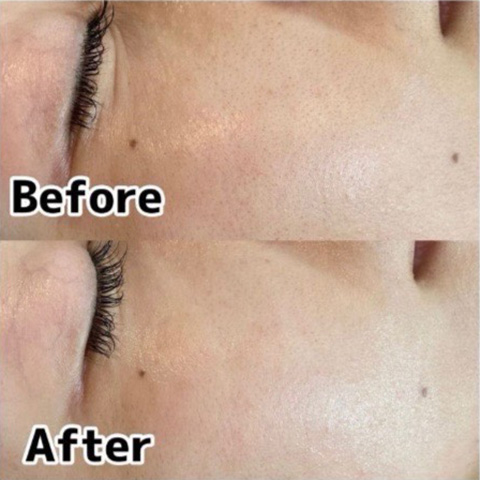 ムートンホイップスパ施術前後の肌の様子