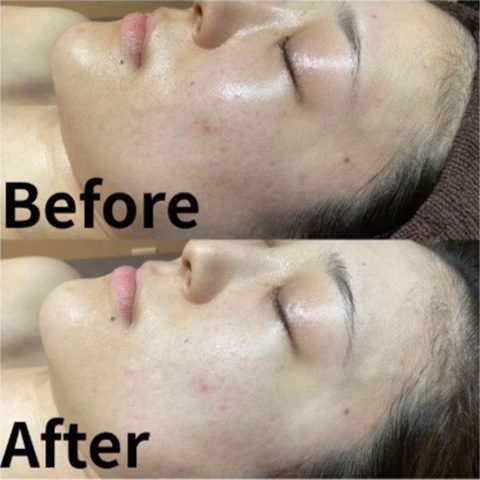 ムートンホイップスパ施術前後の肌の様子