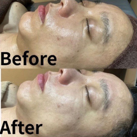 ムートンホイップスパ施術前後の肌の様子